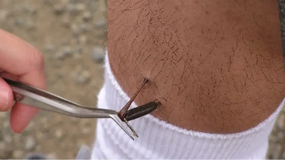 【写真】吸血したヤマビルをピンセットで除去する様子